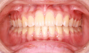 出っ歯、すきっ歯:治療後