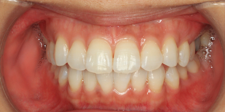 ホワイトニング症例