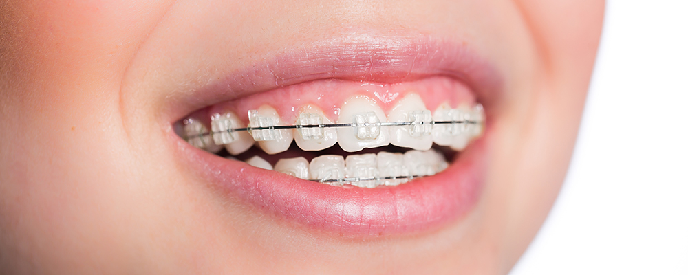 お子さまの矯正費用