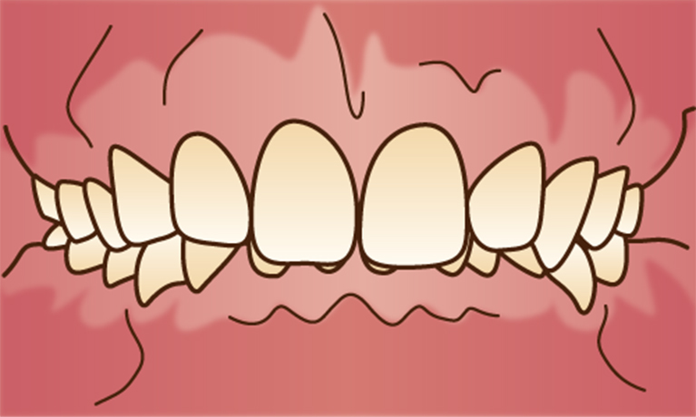 前歯がうまく閉じられない
