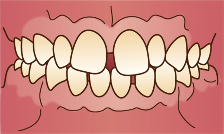 すきっ歯で悩んでいる